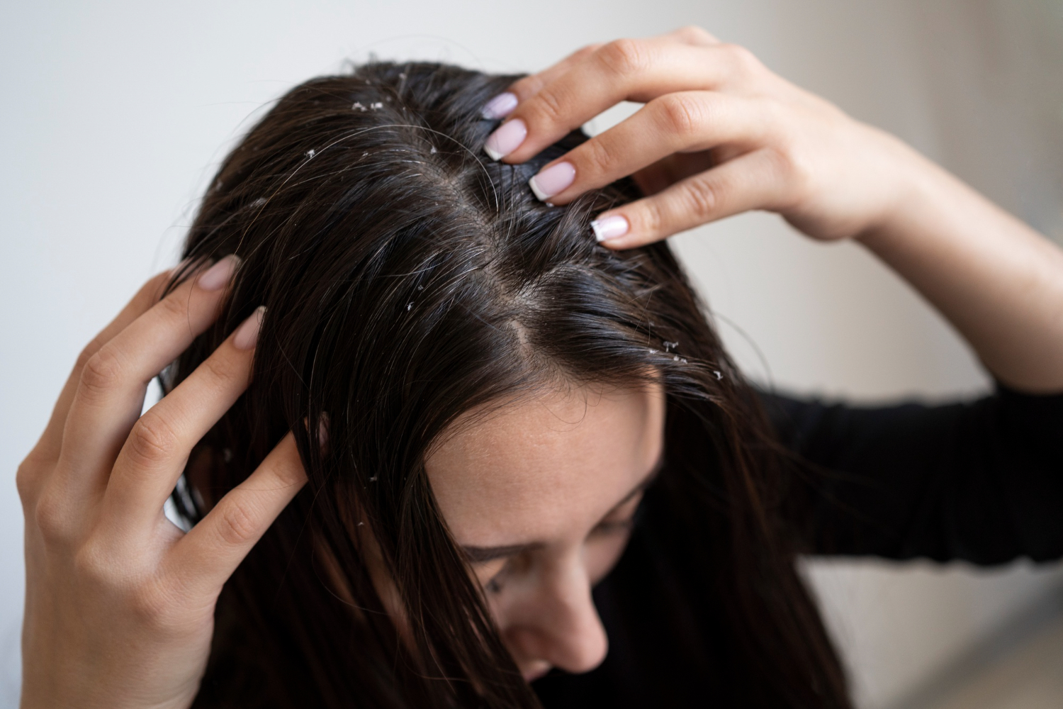 How to Prevent Dandruff Formation on the Hair